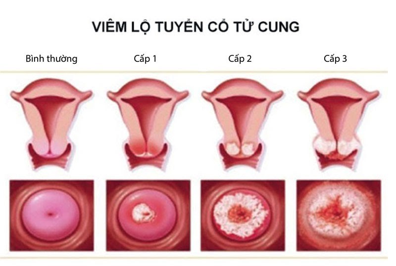 Viem Lo Tuyen Co Tu Cung La Van De Cua Khong It Chi Em 1